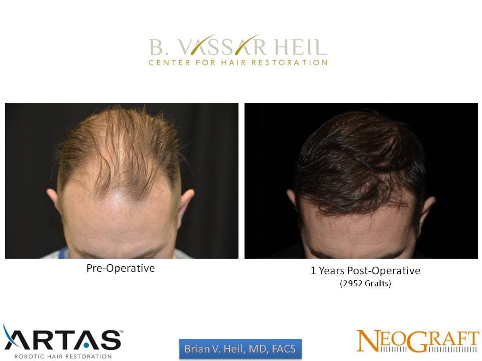 Hair Restoration, Patient 21: before and after