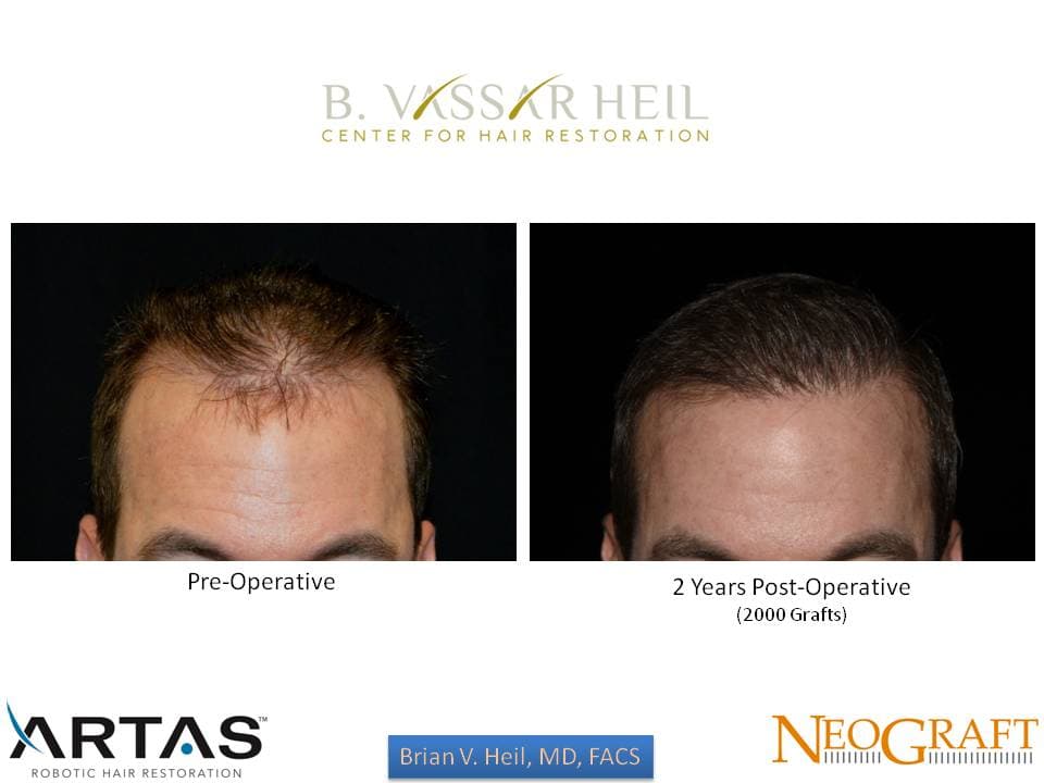 Hair Restoration, Patient 22: before and after