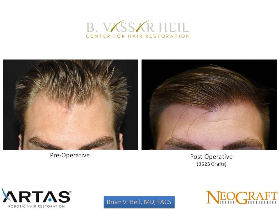 Hair Restoration, Patient 23: before and after