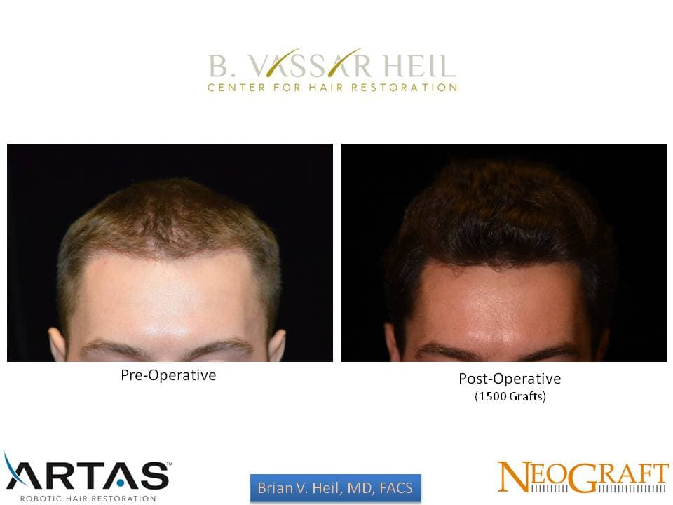 Hair Restoration, Patient 24: before and after