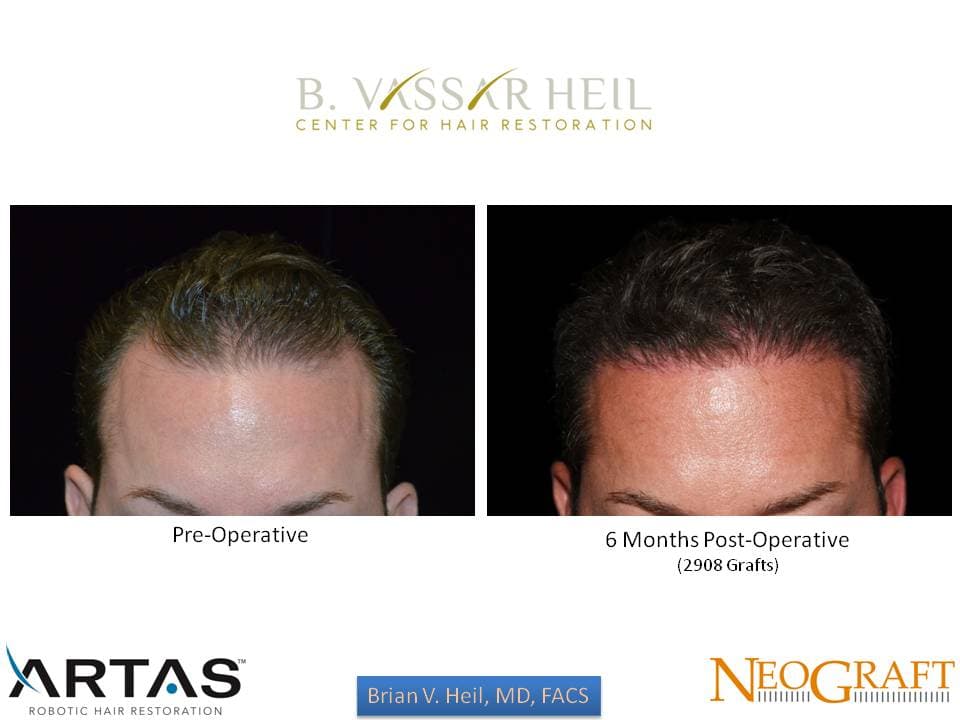 Hair Restoration, Patient 25: before and after
