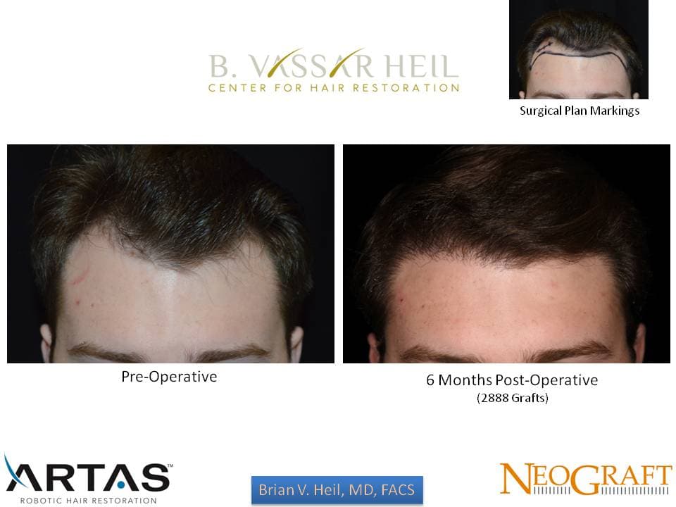 Hair Restoration, Patient 26: before and after