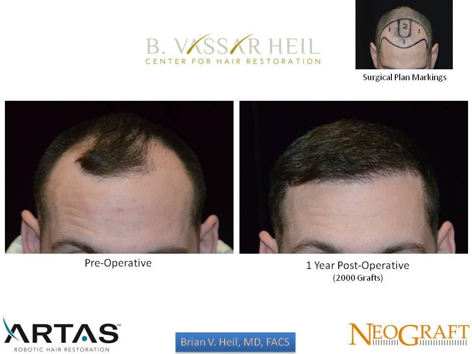 Hair Restoration, Patient 27: before and after
