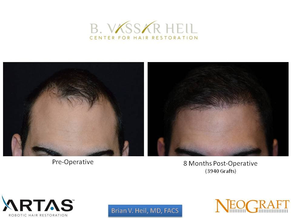 Hair Restoration, Patient 28: before and after