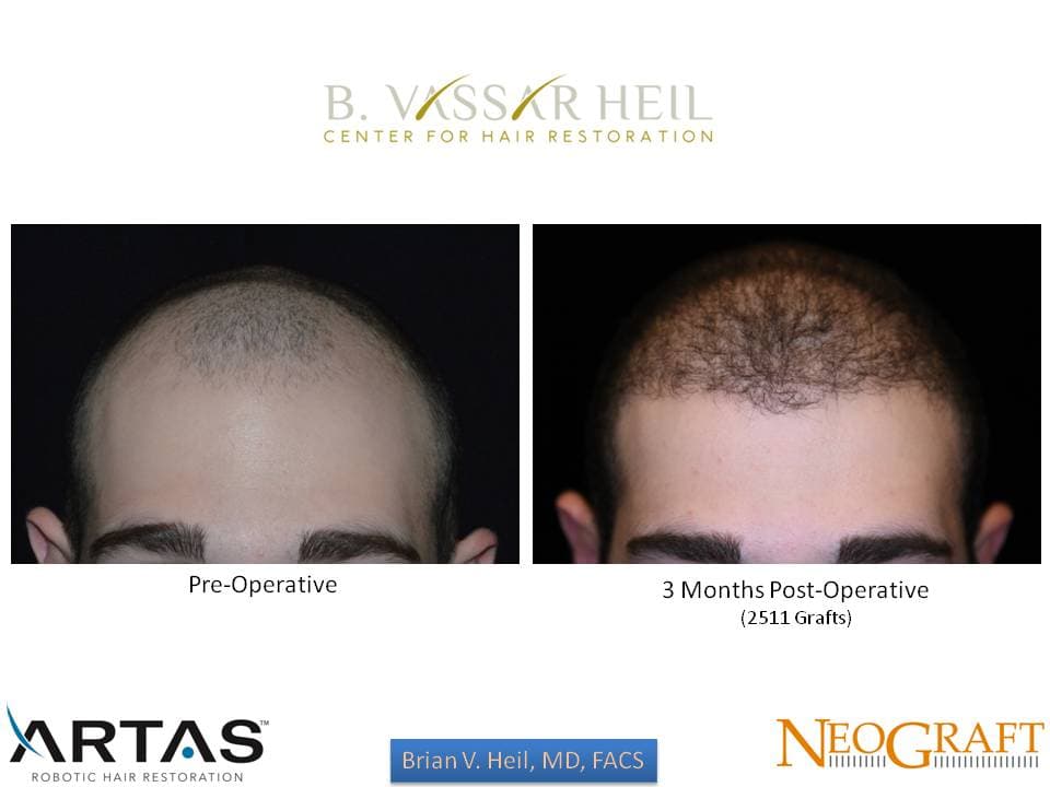 Hair Restoration, Patient 29: before and after