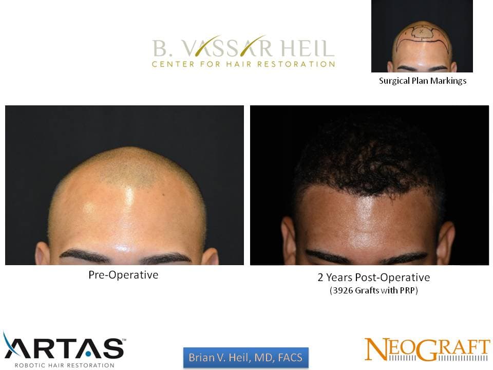 Hair Restoration, Patient 30: before and after
