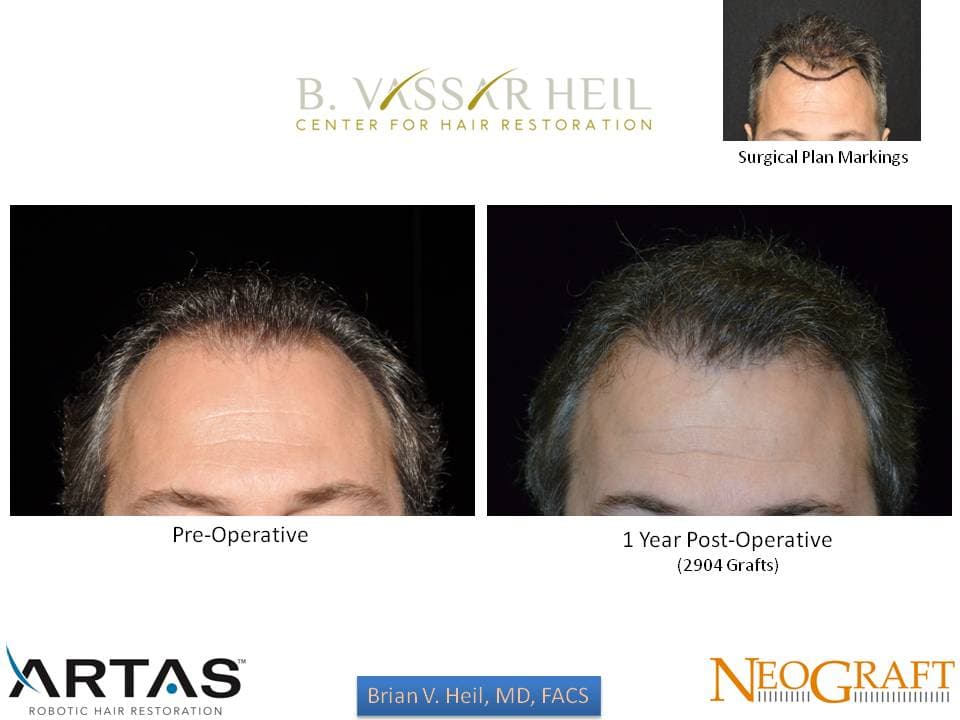 Hair Restoration, Patient 31: before and after