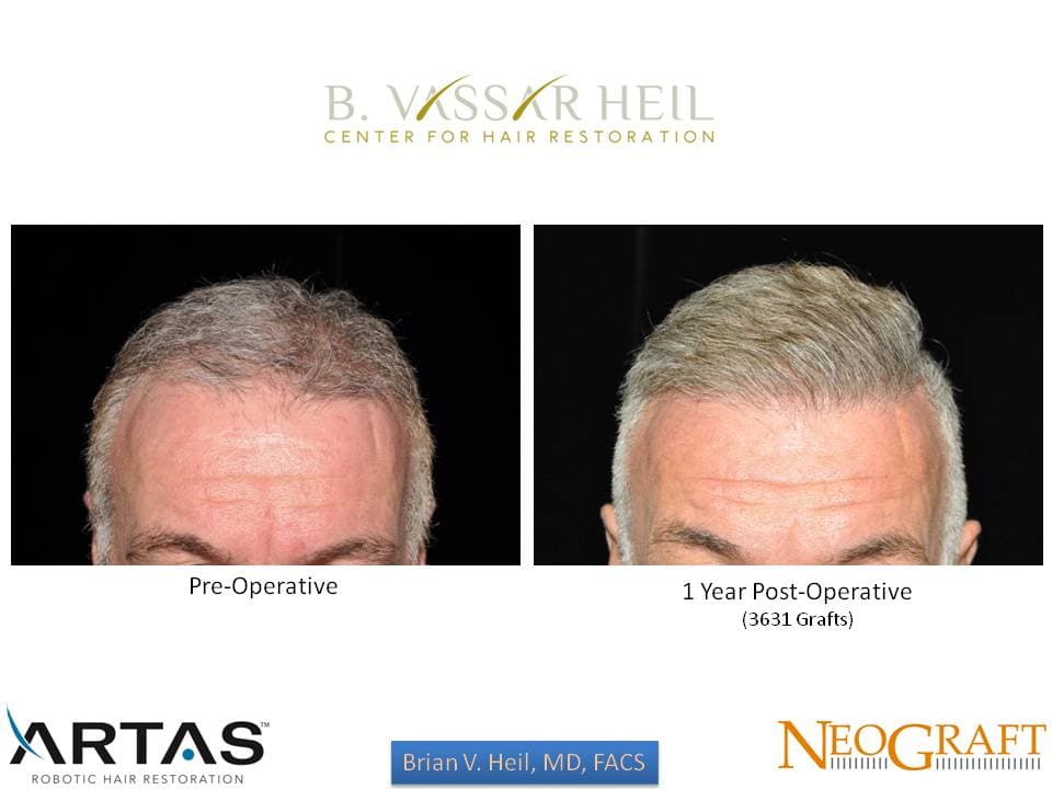 Hair Restoration, Patient 32: before and after