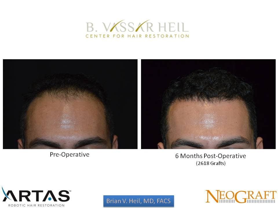 Hair Restoration, Patient 33: before and after
