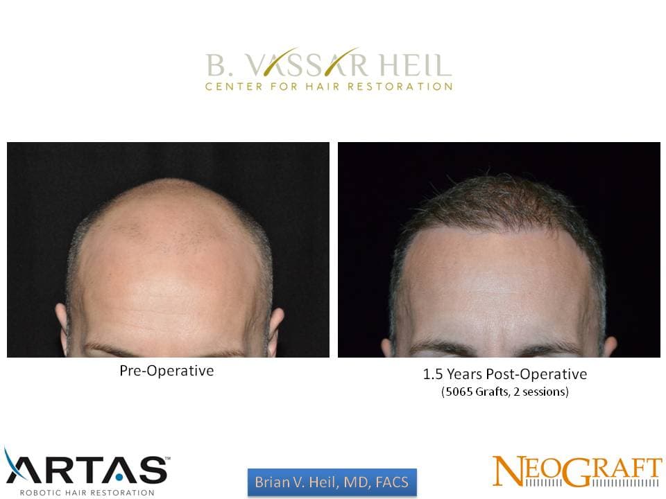 Hair Restoration, Patient 34: before and after