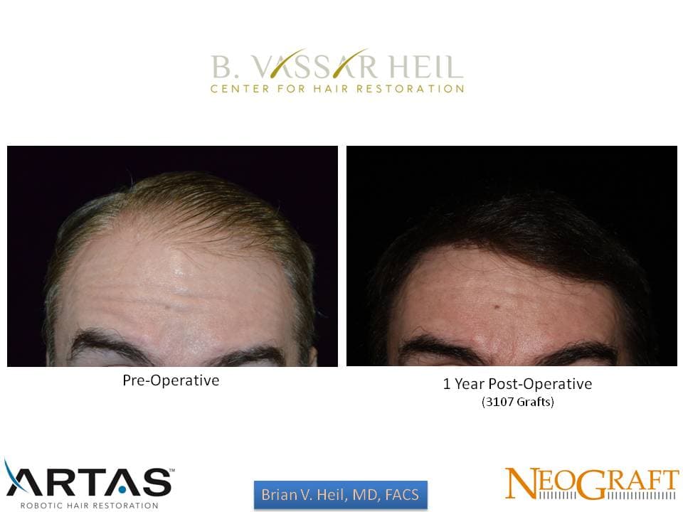 Hair Restoration, Patient 35: before and after