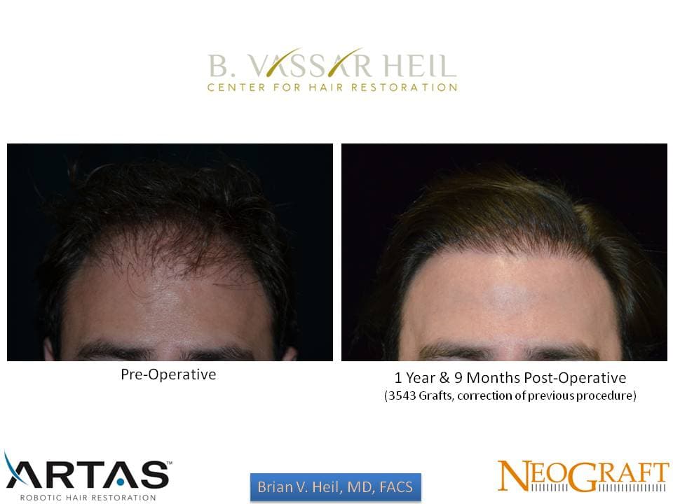 Hair Restoration, Patient 36: before and after