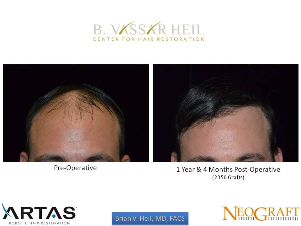 Hair Restoration, Patient 37: before and after