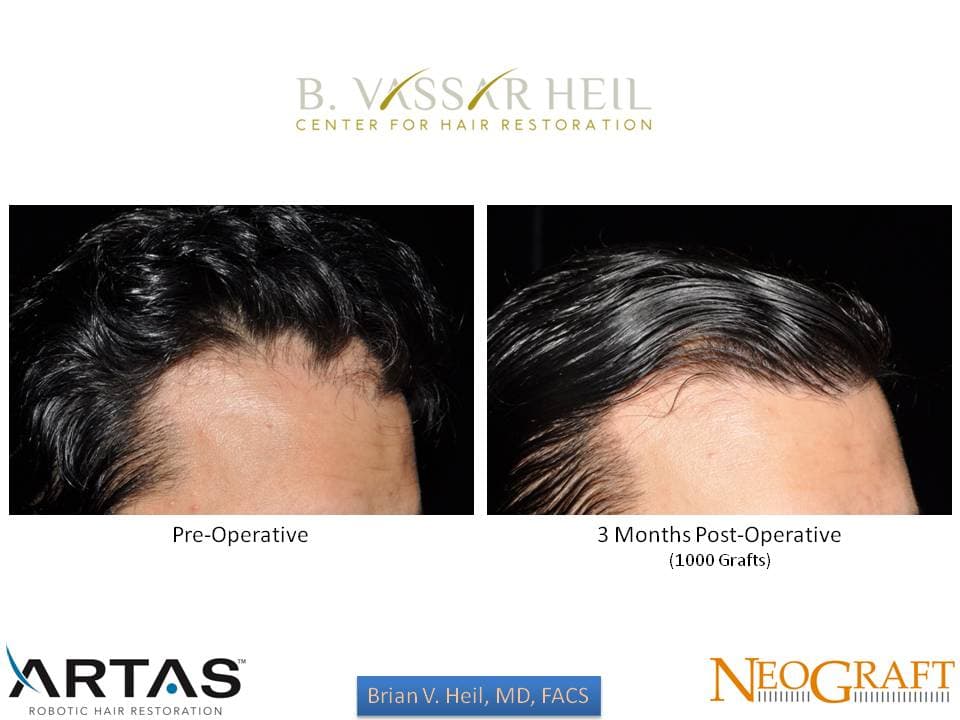 Hair Restoration, Patient 38: before and after
