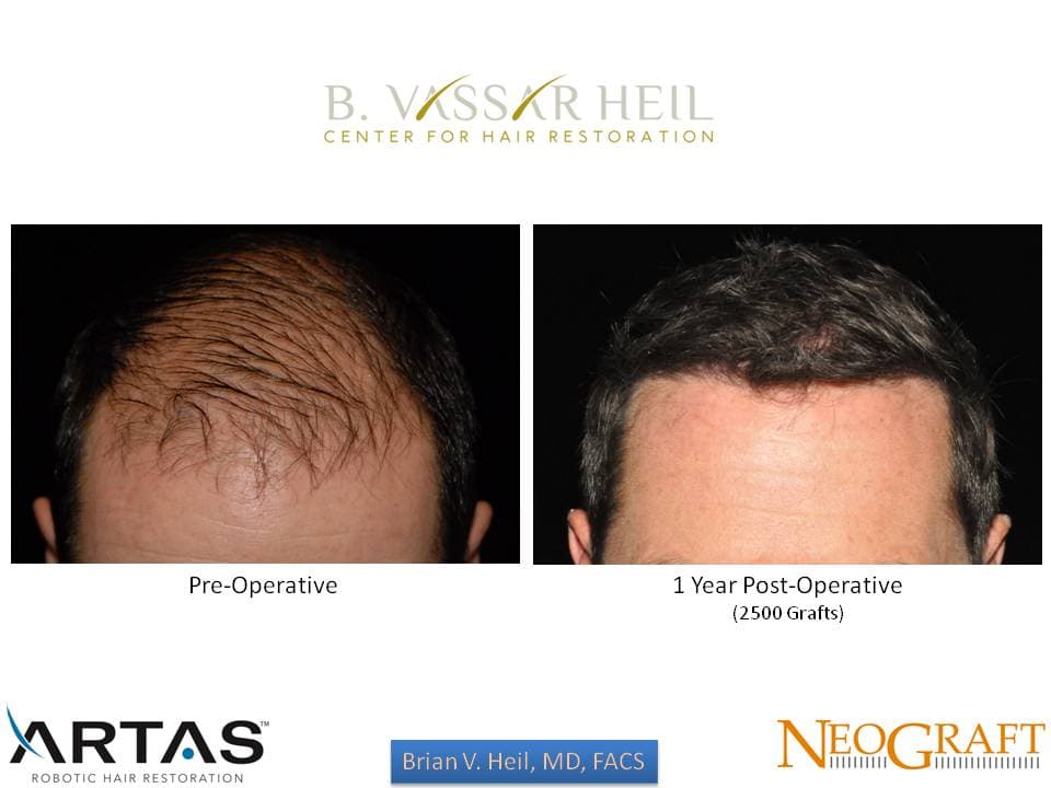 Hair Restoration, Patient 39: before and after