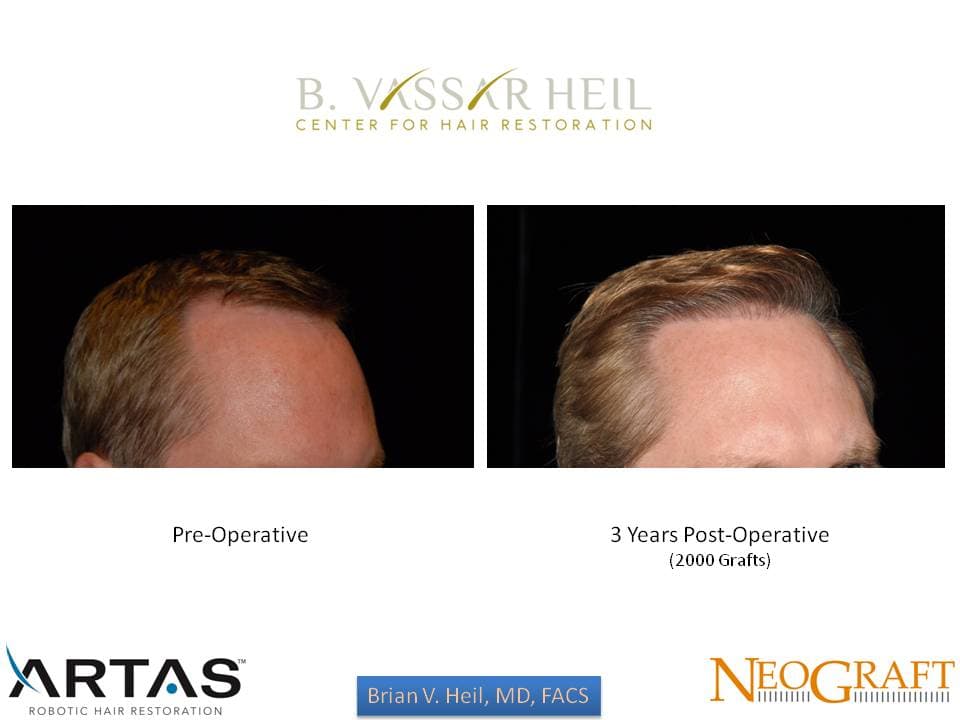 Hair Restoration, Patient 40: before and after