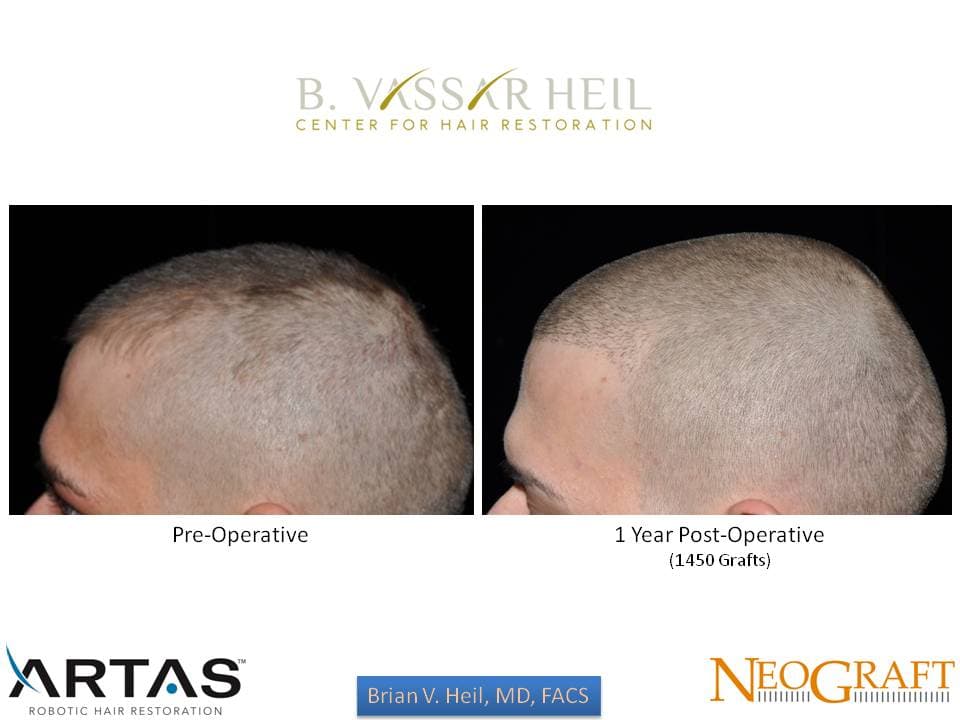 Hair Restoration, Patient 41: before and after