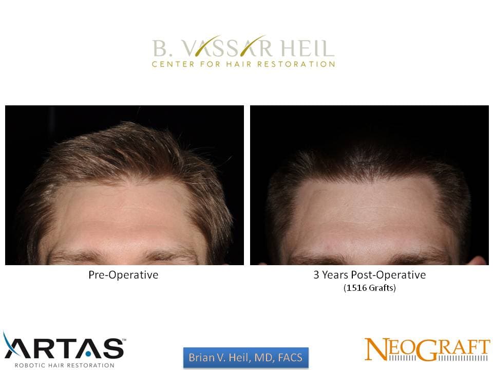 Hair Restoration, Patient 42: before and after