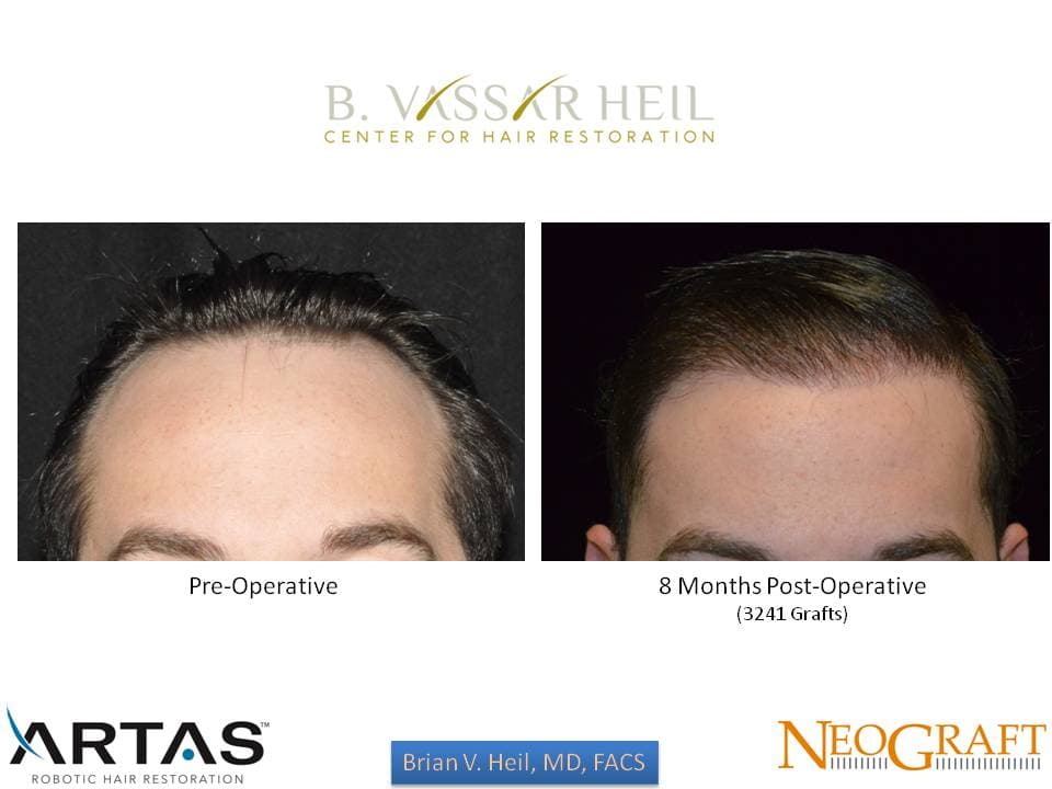 Hair Restoration, Patient 43: before and after