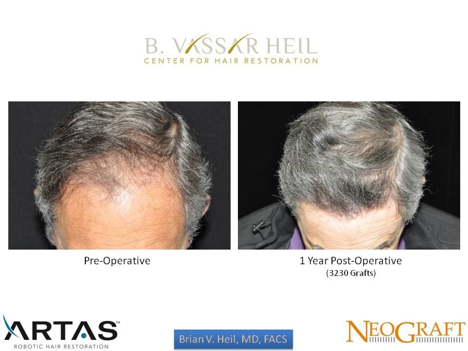 Hair Restoration, Patient 44: before and after