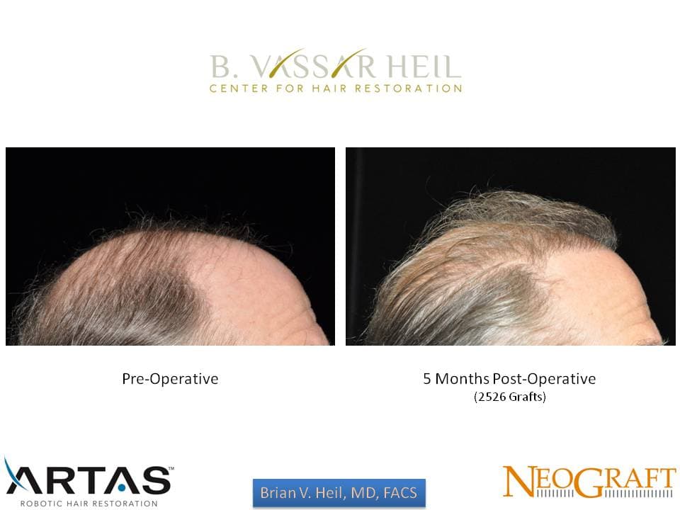 Hair Restoration, Patient 45: before and after
