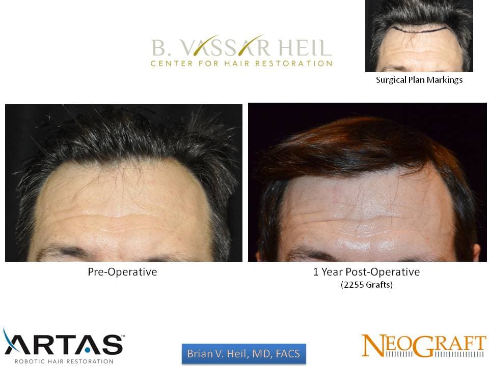 Hair Restoration, Patient 46: before and after