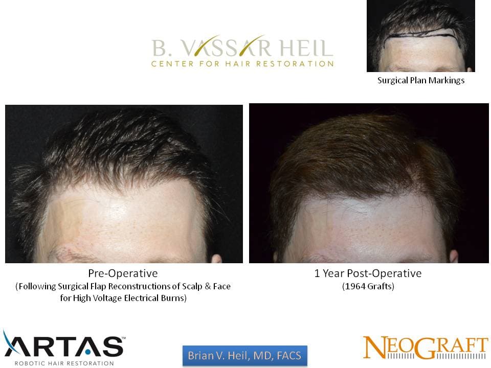 Hair Restoration, Patient 47: before and after