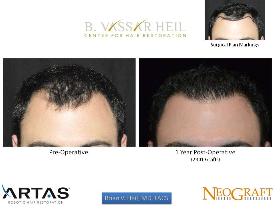Hair Restoration, Patient 48: before and after