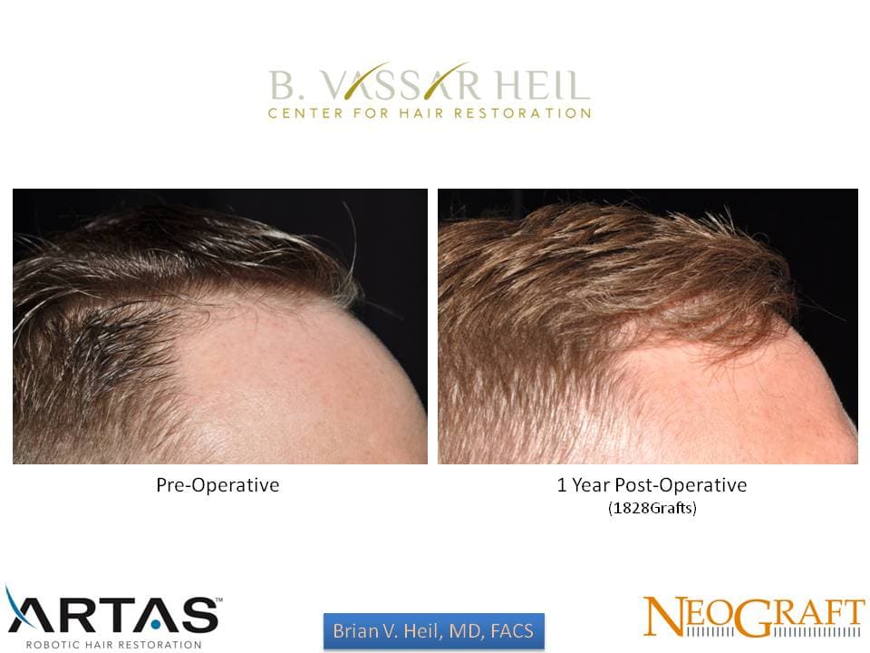 Hair Restoration, Patient 49: before and after