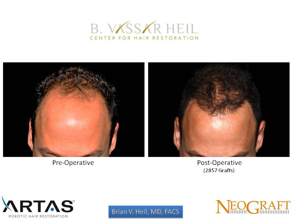Hair Restoration, Patient 51: before and after