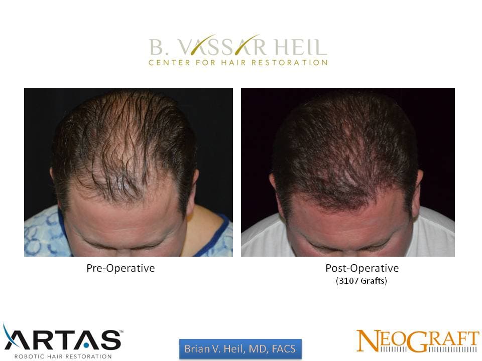 Hair Restoration, Patient 52: before and after