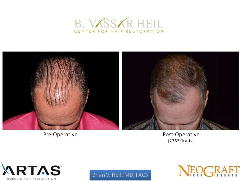Hair Restoration, Patient 53: before and after