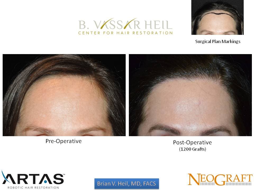 Hair Restoration, Patient 54: before and after