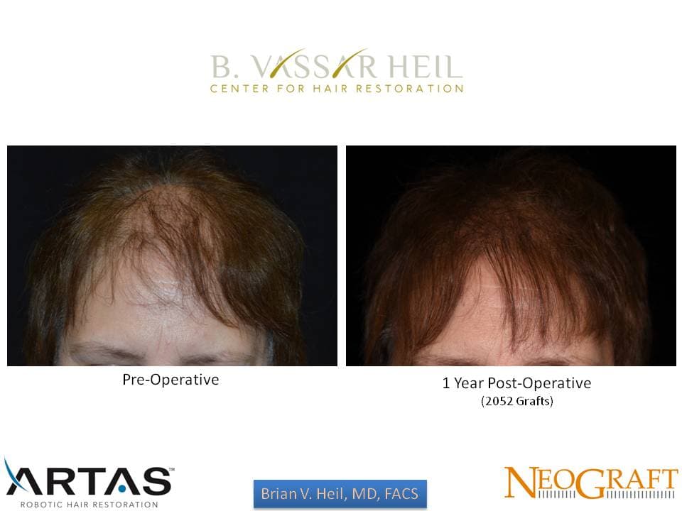 Hair Restoration, Patient 55: before and after