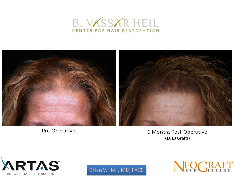 Hair Restoration, Patient 56: before and after