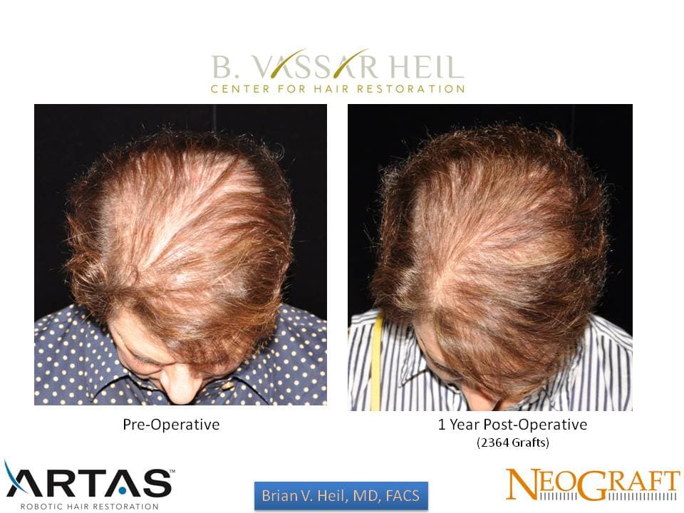 Hair Restoration, Patient 57: before and after