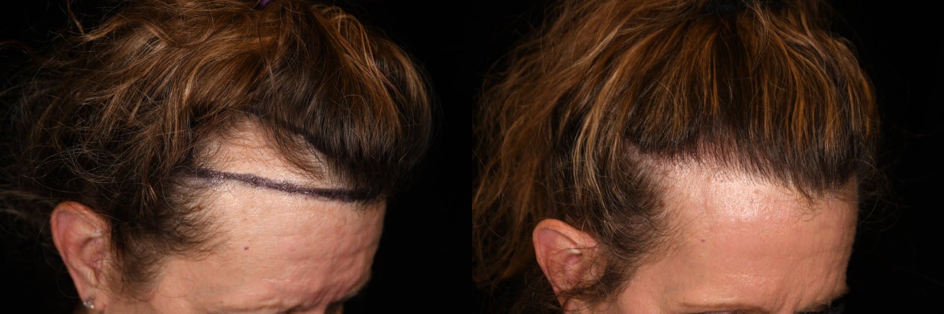 Hair restoration, Hairline and temples, 2026: before and after