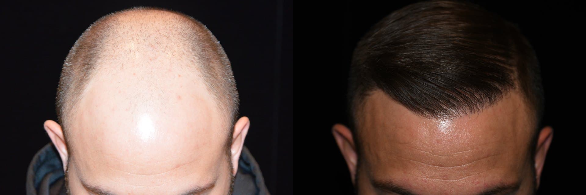 Hair Restoration, Crown and hairline, 2026: before and after