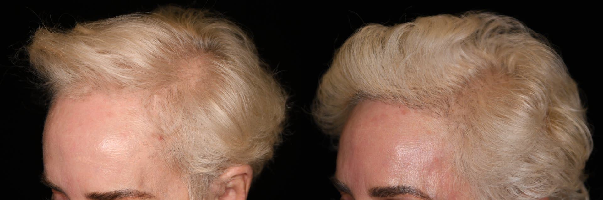 Hair restoration, Frontal density, 2026: before and after