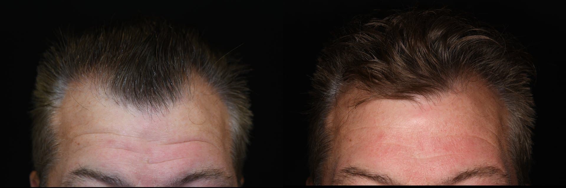 Hair restoration, Hairline, 2026: before and after