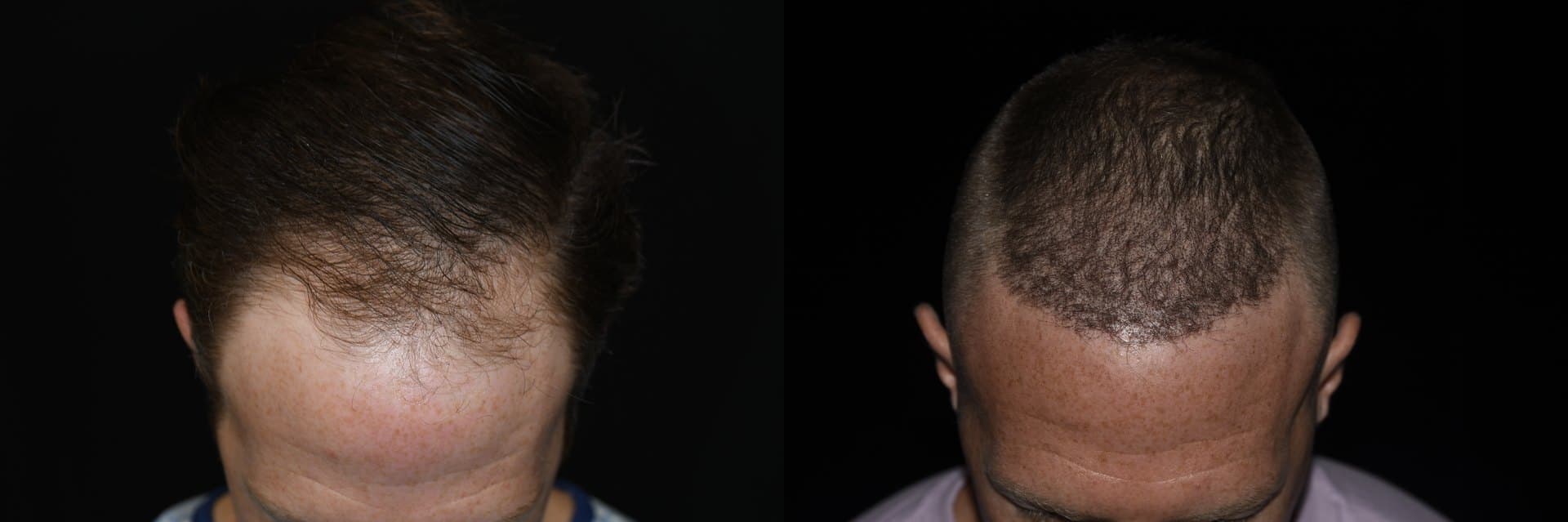 Hair Restoration, Frontal and crown, 2026: before and after