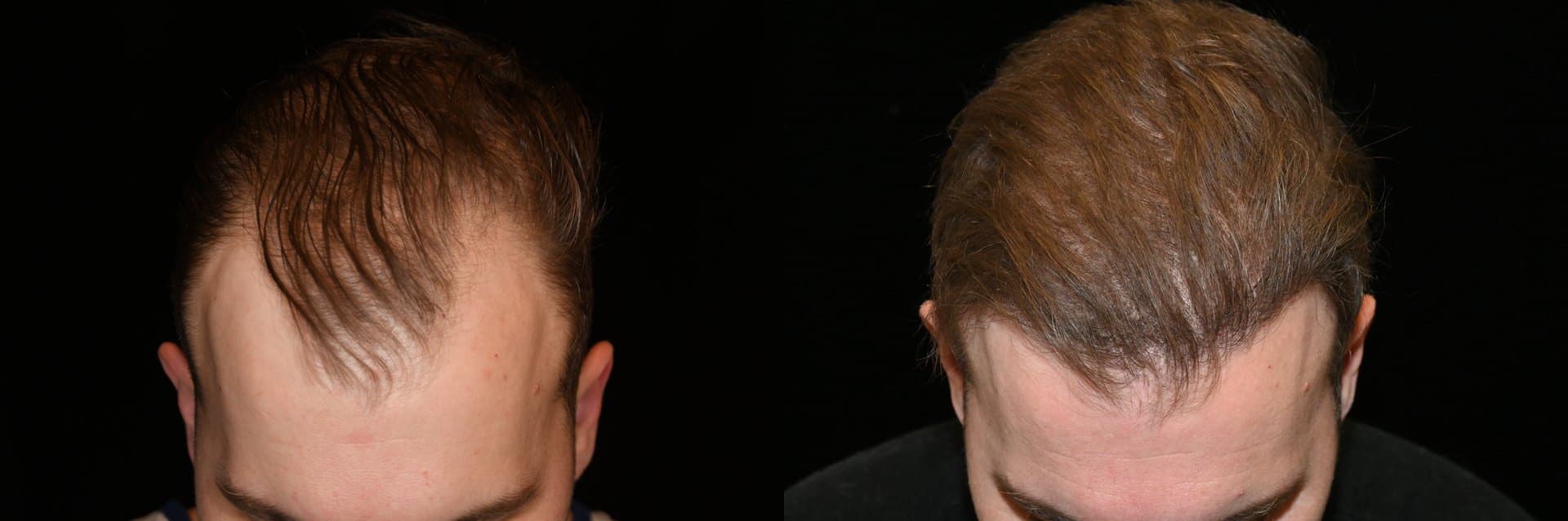 Hair Restoration, Hairline and temples, 2026: before and after