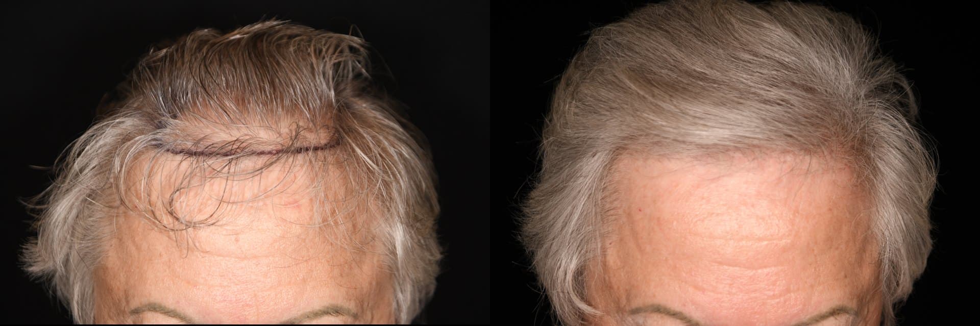 Hair Restoration, Frontal density, 2026: before and after