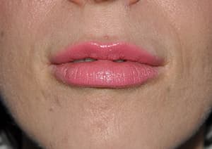 Juvéderm, lips, after