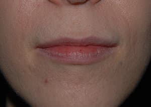 Juvéderm, lips, before