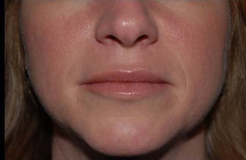 Juvéderm, lower face, after