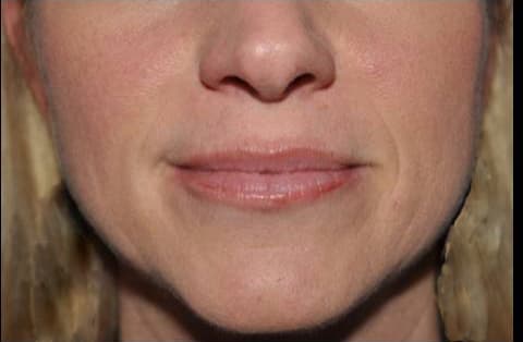 Juvéderm, lower face, before
