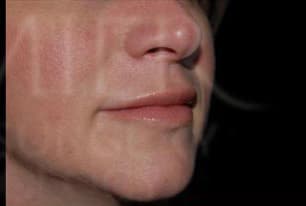Juvéderm, nasolabial folds, after