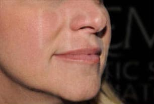Juvéderm, nasolabial folds, before