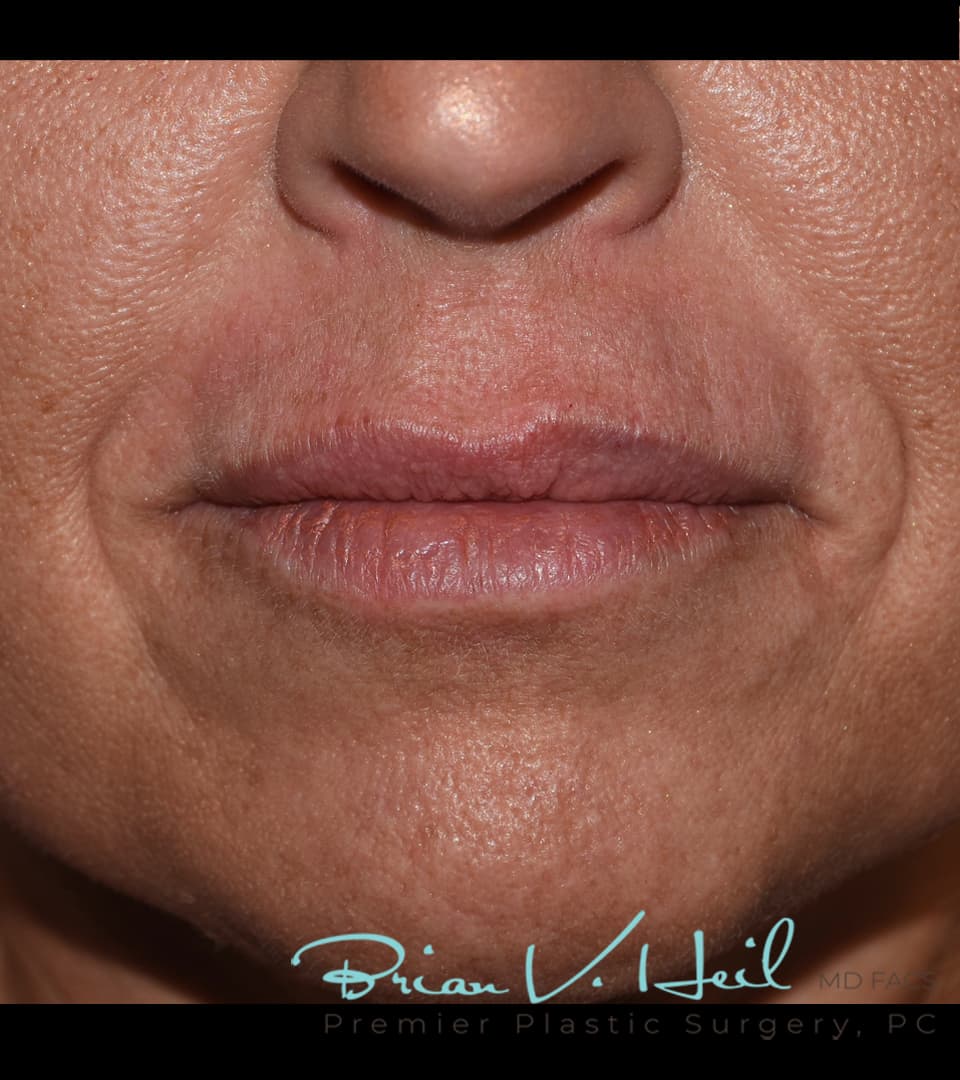 Juvéderm, perioral lines, after